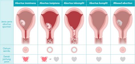 icd 10 abortus incomplete | PDF B Y T CNG HA X