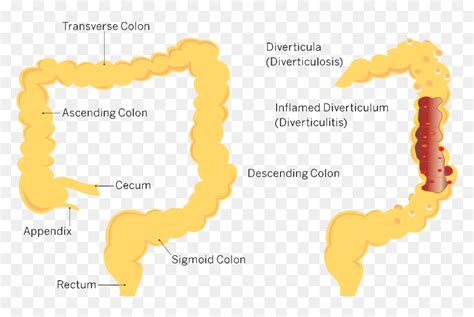 Icd 10 Code For Diverticulosis