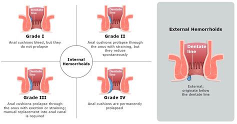 Icd 10 Hemorrhoids
