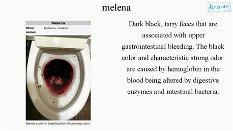 Icd 10 Melena