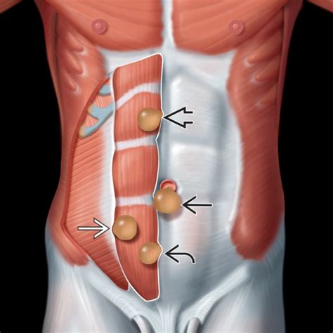 Icd 10 Ventral Hernia