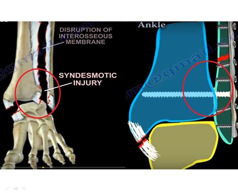 Icd 9 Code Syndesmosis Disruption