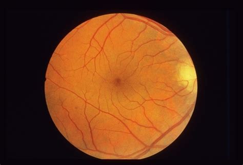 icd10 - H35073: Retinal telangiectasis, bilateral