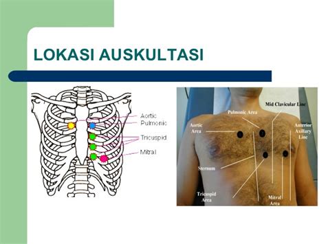 ictus cordis adalah | Cch pht m Ictus cordis trong B