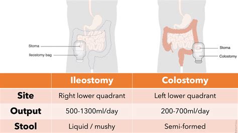 Ileostomy Vs Colostomy