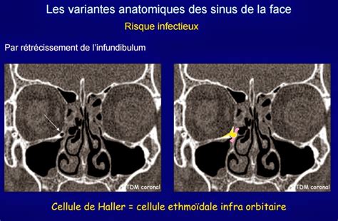 imagerie des sinus