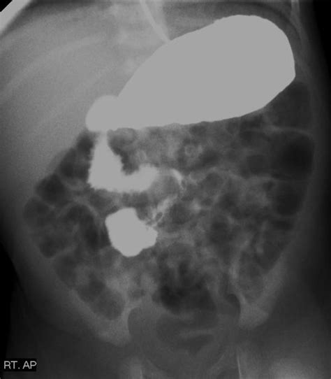 Imaging Intestinal Malrotation