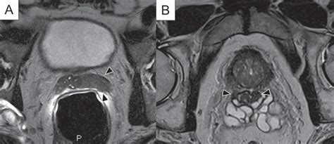 Imaging Of The Prostate Current Trends And Future