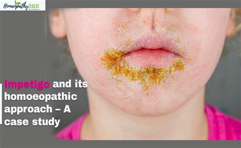 Impetigo Icd 10