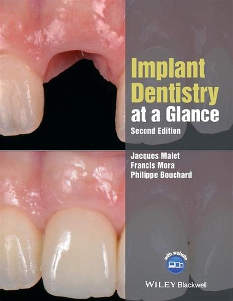 Full Download Implant Dentistry At A Glance 