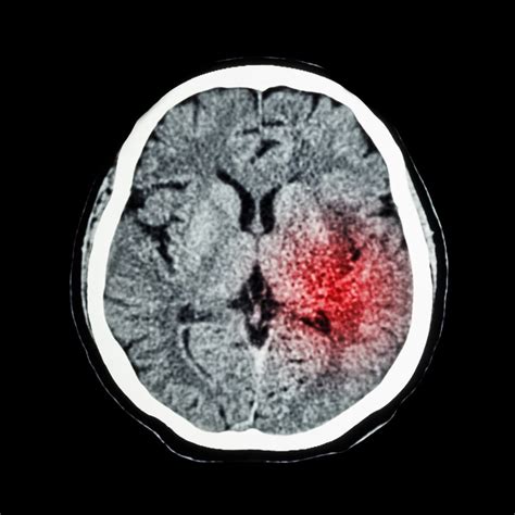 infarto cerebral