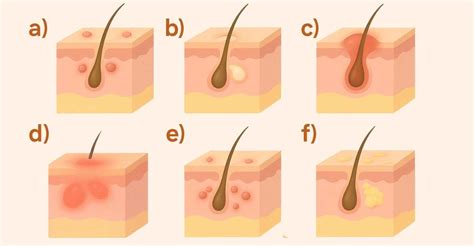 inflammation finnar bölder