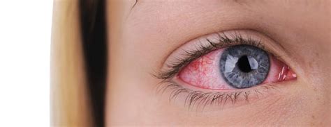 Ini Penyebab Mata Anak Belekan Virus Atau Bakteri Cara Mengatasi Flu Mata - Cara Mengatasi Flu Mata