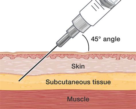 Injection Subcutaneous Sites