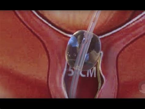 inleiden bevalling procedure