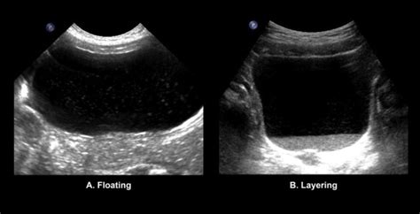 Internal Echoes In Urinary Bladder