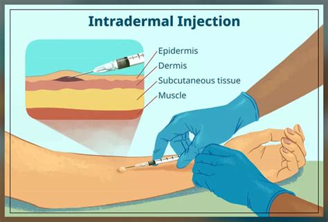 Intradermal Injection Sites