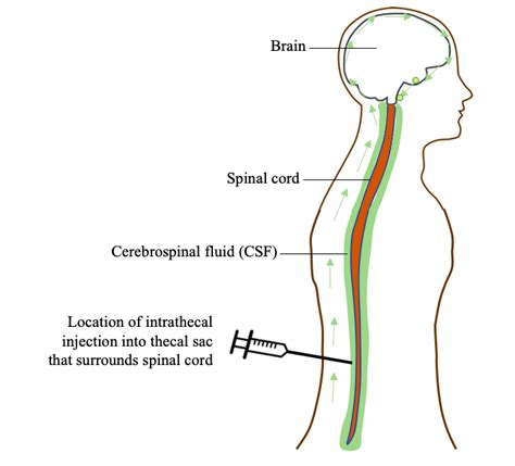 Intrathecal Route Example