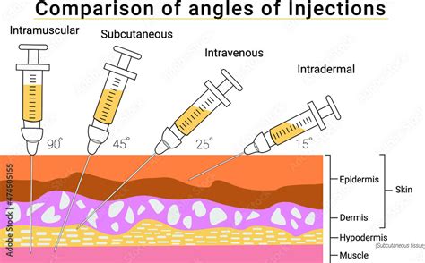 Intravenous Injection Angle