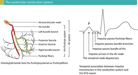 Intraventricular Conduction Delay