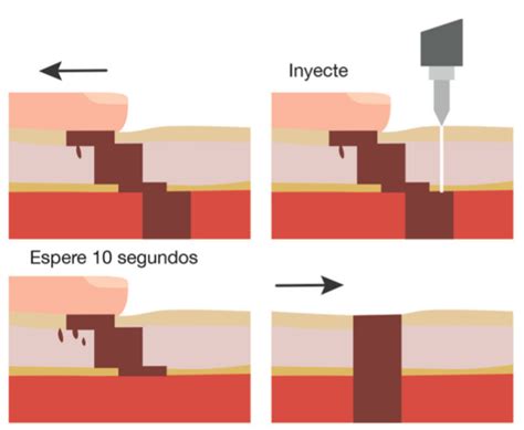 Inyección En Z