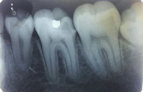 Iopa X Ray