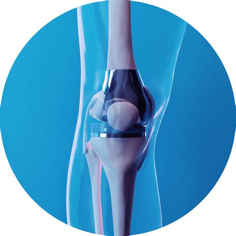 iovera Prior to Knee Surgery Joint Replacement Patient Forum