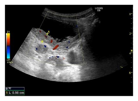 Irregular Bladder Wall Thickening Us