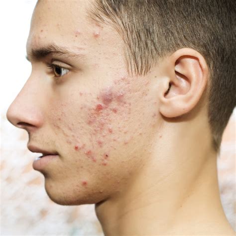 is acne unattractive to guys pictures
