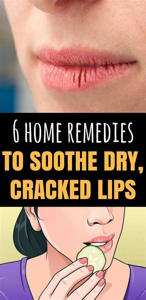 is ice good for chapped lips treatment
