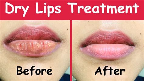is ice good for dry lips treatment