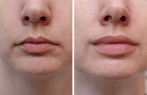 is kissing different after lip fillers surgery