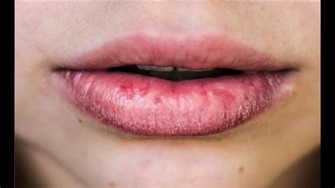 is kissing good for chapped lips without bleeding