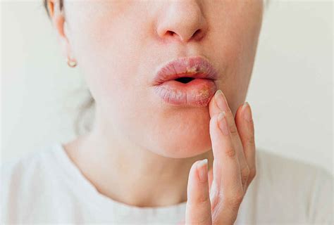 is kissing good for your lips symptoms treatment