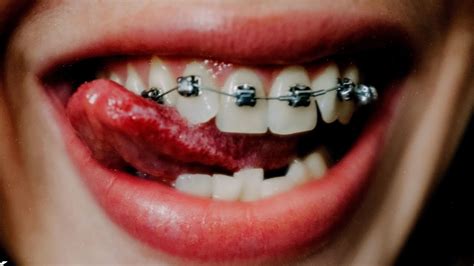 is kissing with braces bad for your face