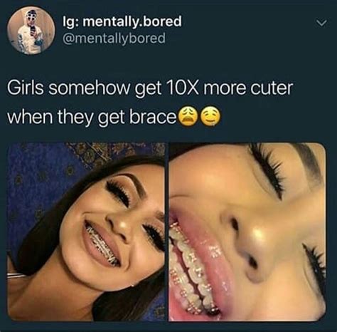 is kissing with braces weird pictures funny pictures