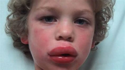 is lip swelling a sign of anaphylaxis children