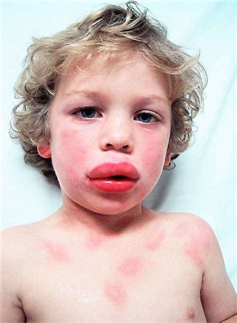 is lip swelling a sign of anaphylaxis coronavirus