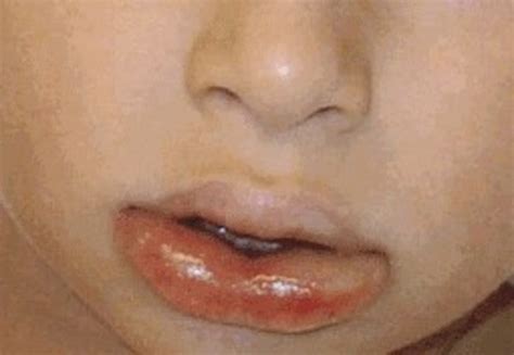 is lip swelling a sign of anaphylaxis