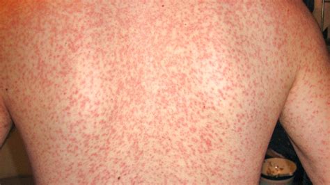 is mono rash contagious
