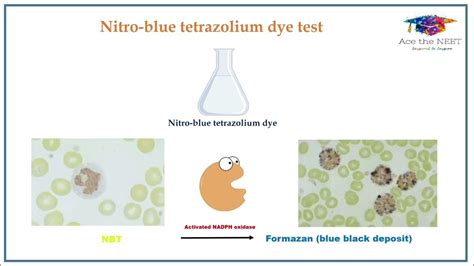 Is Nitro Blue Test Negative In Cgd