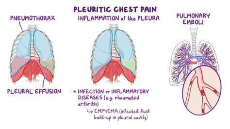 Is Pleurisy Contagious