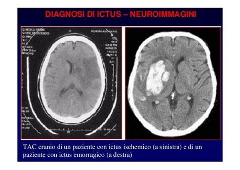 ischemia cronica alla testa