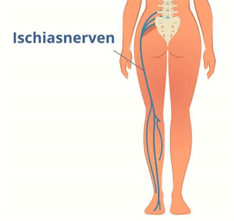 ischiasnerven symtom