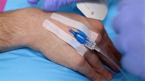 Iv Cannulation Procedure