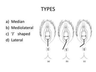 J Shaped Episiotomy