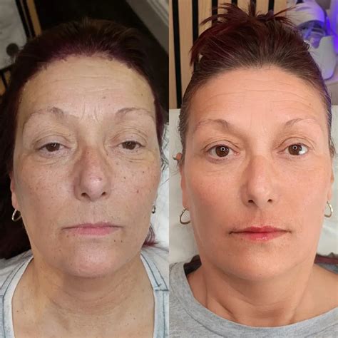 Jalupro Under Eye Treatment Prestige Aesthetics