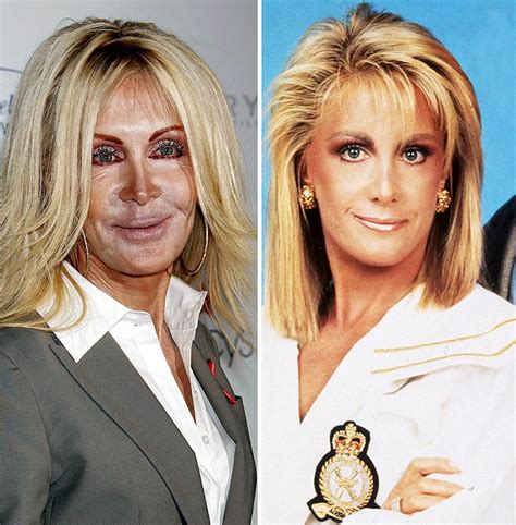 joan van ark actress plastic surgery