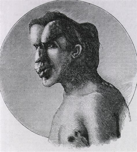 joseph merrick biography