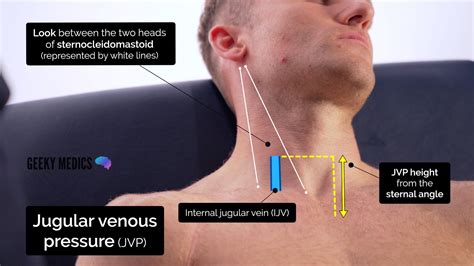 Jugular Venous Pressure